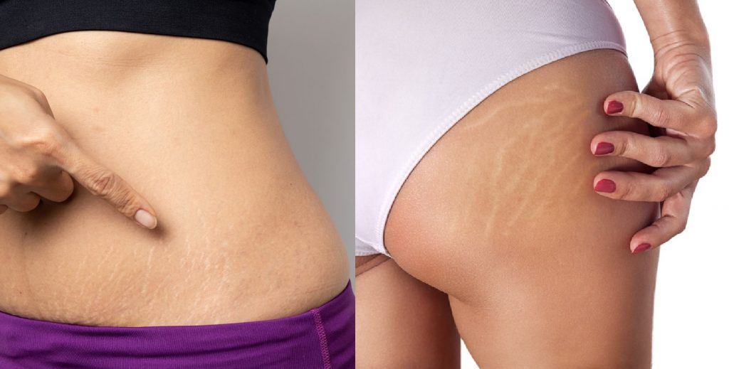 How to reduce stretch marks from body with proven methods